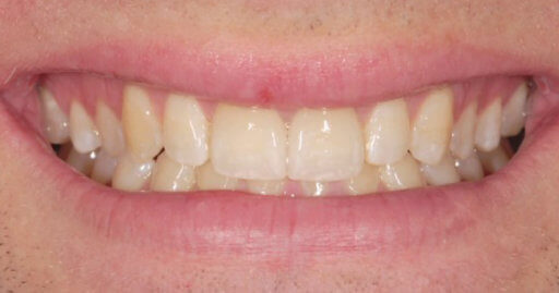 patient teeth 2 after