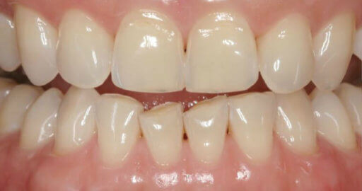 patient teeth 3 before