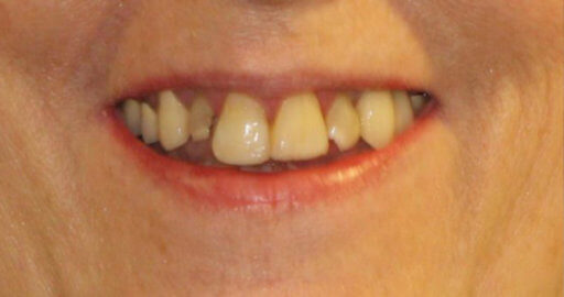 patient teeth 4 before