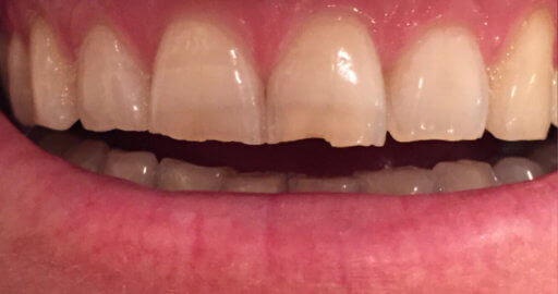 patient teeth 5 before
